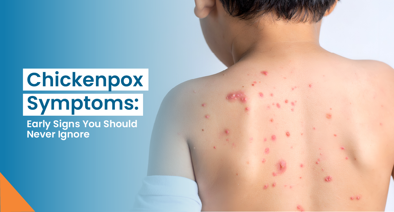 Chickenpox Symptoms: Early Signs You Should Never Ignore